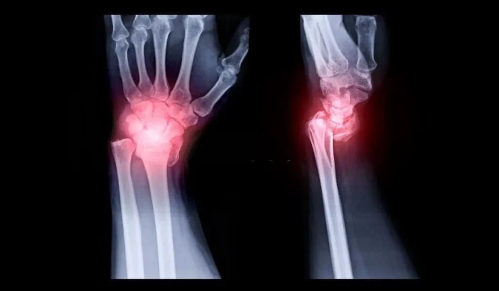 Understanding Scaphoid Fractures